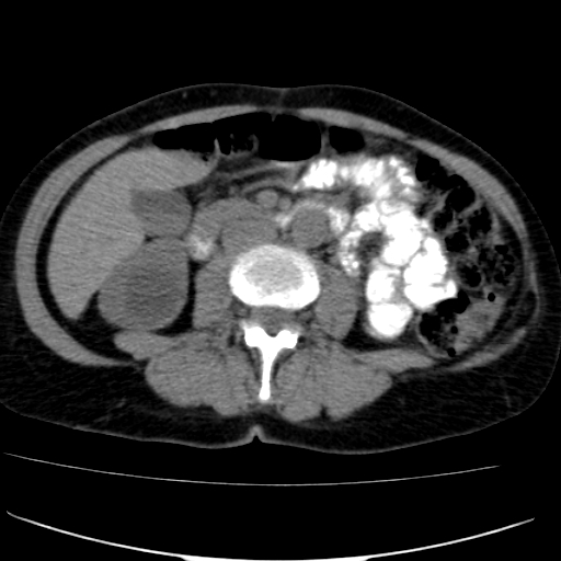 File:Atypical renal cyst (Radiopaedia 17536-17251 non-contrast 22).jpg