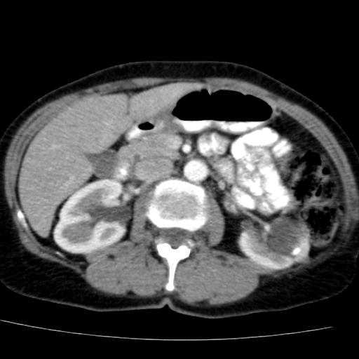 File:Atypical renal cyst (Radiopaedia 17536-17251 renal cortical phase 17).jpg