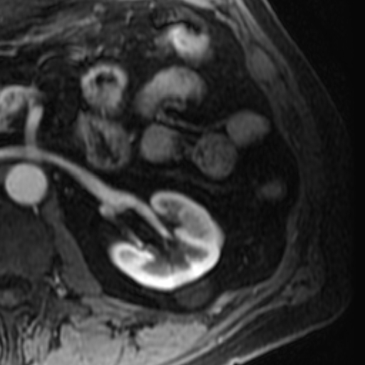 File:Atypical renal cyst on MRI (Radiopaedia 17349-17046 C 15).jpg