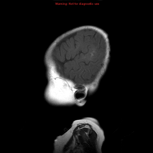 File:Atypical teratoid rhabdoid tumor (Radiopaedia 10712-11183 Sagittal T1 19).jpg