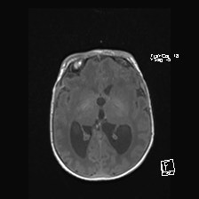 Atypical teratoid rhabdoid tumor (prenatal US and neonatal MRI) (Radiopaedia 59091-66388 Axial T1 30).jpg