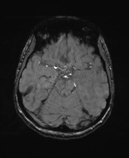 Autoimmune limbic encephalitis (Radiopaedia 30363-31005 SWI - magnitude 28).jpg