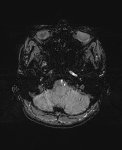 Autoimmune limbic encephalitis (Radiopaedia 30363-31005 SWI 12).jpg