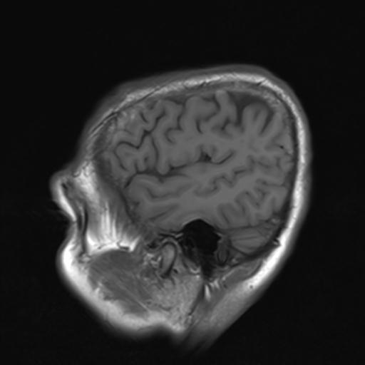 File:Autoimmune limbic encephalitis (Radiopaedia 30363-31005 Sagittal T1 22).jpg