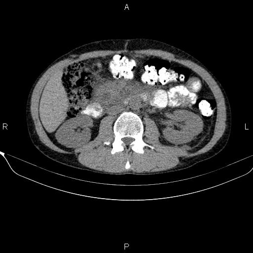 Autoimmune pancreatitis (Radiopaedia 84925-100431 Axial non-contrast 27).jpg