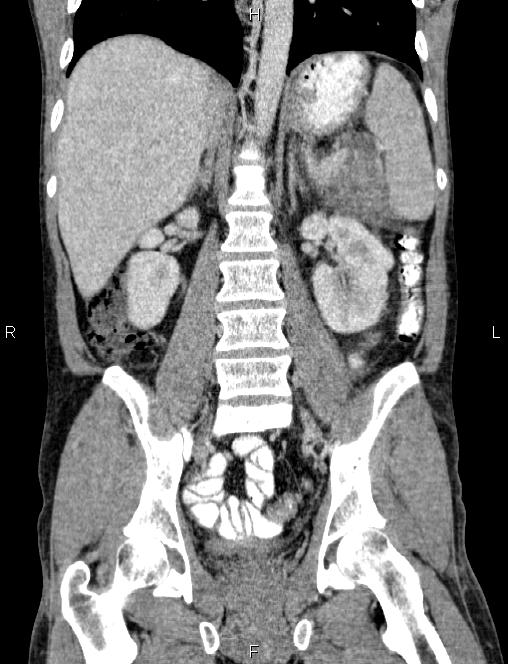 Autoimmune pancreatitis (Radiopaedia 84925-100431 D 37).jpg