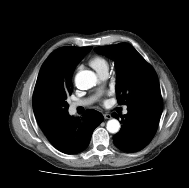 Autosomal dominant polycystic kidney disease (Radiopaedia 27851-28094 B 30).jpg