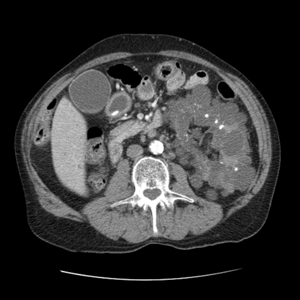 Autosomal dominant polycystic kidney disease (Radiopaedia 27851-28094 B 75).jpg
