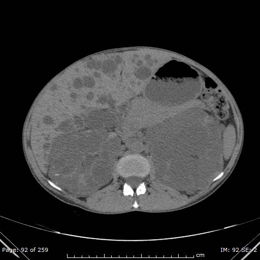 File:Autosomal dominant polycystic kidney disease (Radiopaedia 44122-47684 Axial non-contrast 33).jpg