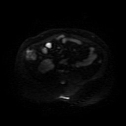 File:Autosomal dominant polycystic kidney disease (Radiopaedia 50259-55611 Axial DWI 34).jpg