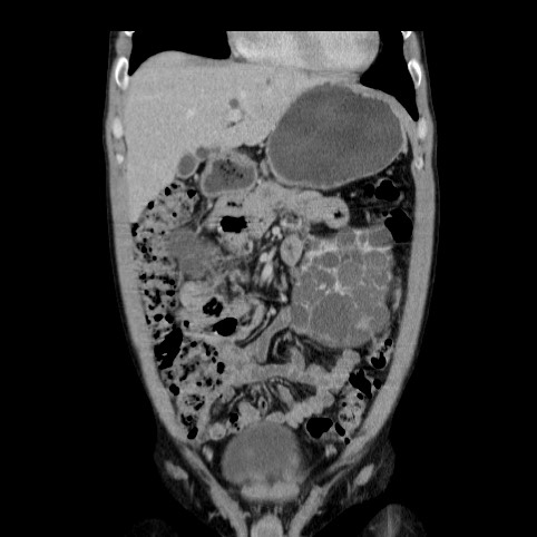 Autosomal dominant polycystic kidney disease (Radiopaedia 66349-75582 A 16).jpg