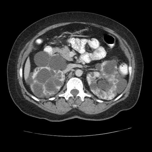 Autosomal dominant polycystic kidney disease with hepatic involvement (Radiopaedia 32693-33662 B 30).jpg
