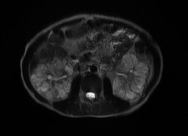 File:Autosomal recessive polycystic kidney disease (Radiopaedia 11224-11589 Axial T2 fat sat 1).jpg