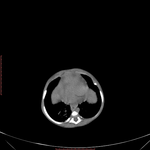 Autosomal recessive polycystic kidney disease associated with Caroli disease (Radiopaedia 61932-69984 Axial non-contrast 95).jpg