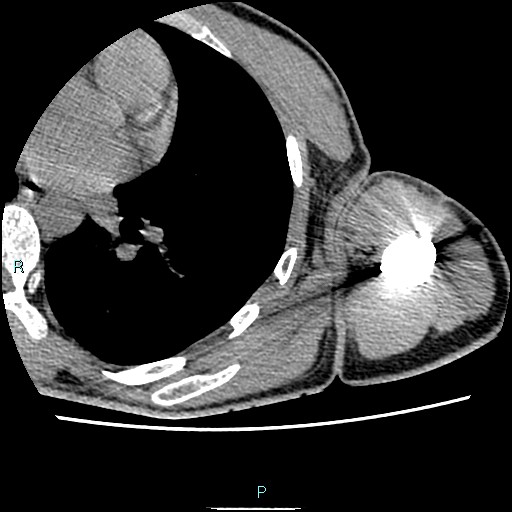 File:Avascular necrosis after fracture dislocations of the proximal humerus (Radiopaedia 88078-104653 D 80).jpg