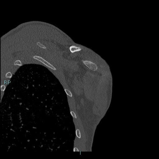 Avascular necrosis after fracture dislocations of the proximal humerus (Radiopaedia 88078-104655 Coronal bone window 113).jpg