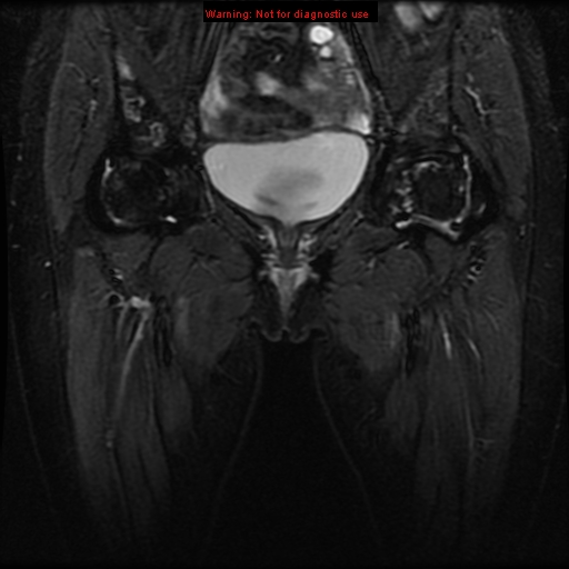 File:Avascular necrosis in sickle cell disease (Radiopaedia 17448-17151 Coronal T2 fat sat 5).jpg