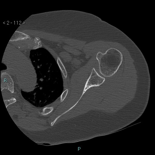 File:Avascular necrosis of the shoulder - Cruess stage I (Radiopaedia 77674-89887 Axial bone window 28).jpg