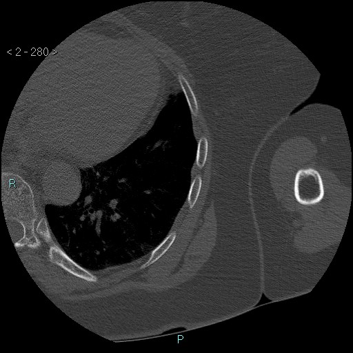 Avascular necrosis of the shoulder - Cruess stage I (Radiopaedia 77674-89887 Axial bone window 70).jpg