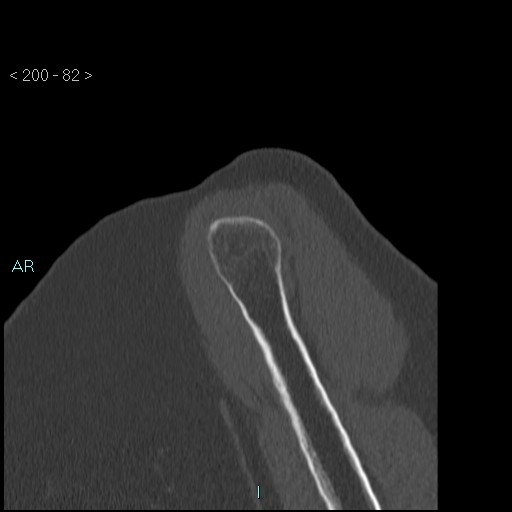 Avascular necrosis of the shoulder - Cruess stage I (Radiopaedia 77674-89887 Sagittal bone window 81).jpg