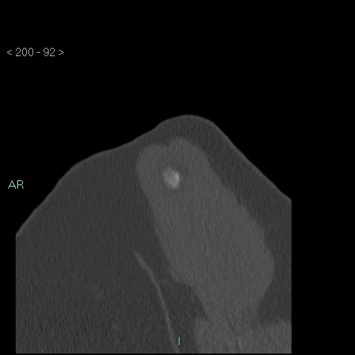 Avascular necrosis of the shoulder - Cruess stage I (Radiopaedia 77674-89887 Sagittal bone window 91).jpg