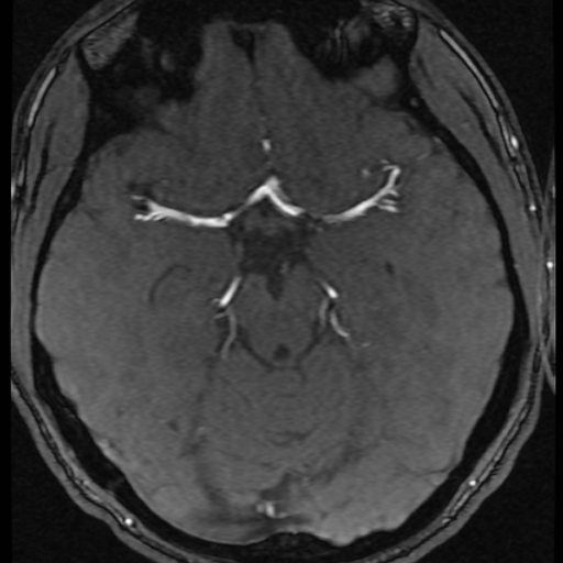 Azygos anterior cerebral artery (Radiopaedia 17059-16756 Axial MRA 41).jpg