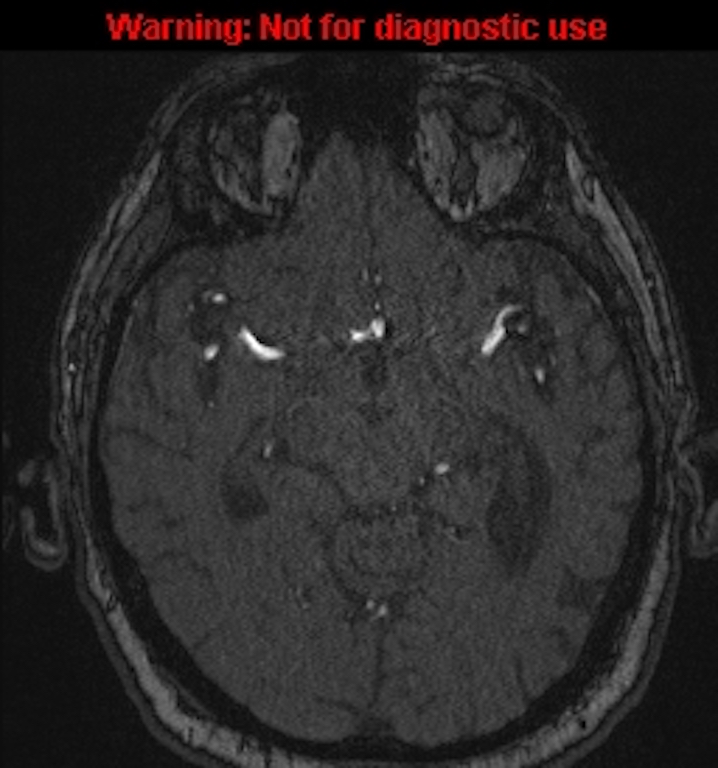 Azygos anterior cerebral artery (Radiopaedia 59325-66677 Axial MRA 72).jpg