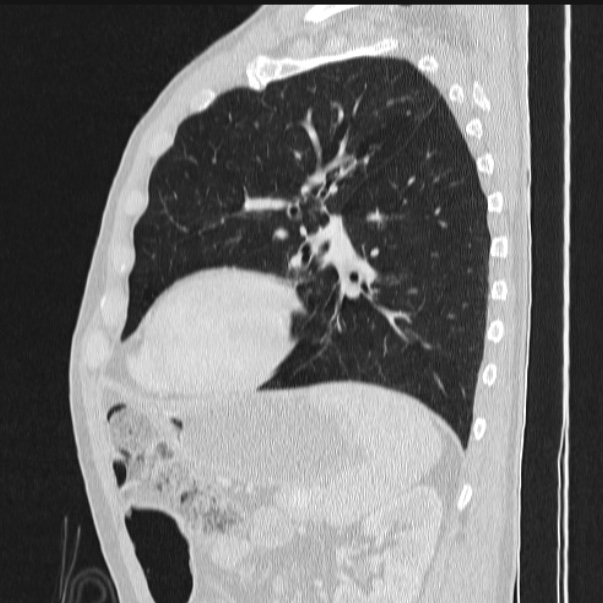 Azygos lobe (Radiopaedia 38259-40275 lung window 69).jpg
