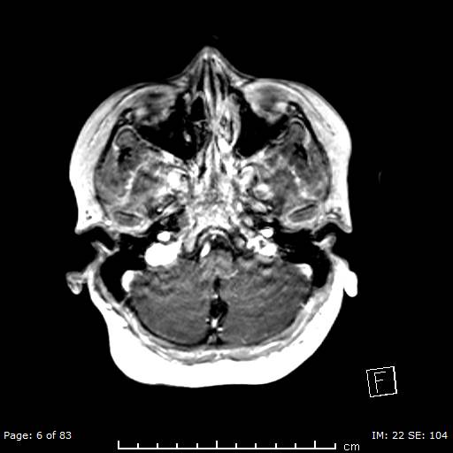 Balo concentric sclerosis (Radiopaedia 61637-69636 Axial T1 C+ 6).jpg