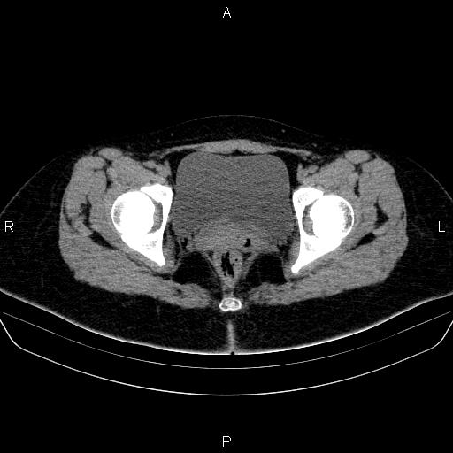 Bartholin gland cyst (Radiopaedia 62635-70930 Axial non-contrast 66).jpg