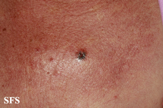 Basal Cell Carcinoma (Dermatology Atlas 251).jpg