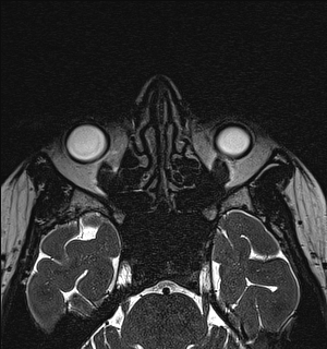 Basal cell carcinoma - nasal region (Radiopaedia 70292-80365 Axial Gradient Echo 59).jpg