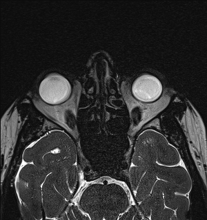 File:Basal cell carcinoma - nasal region (Radiopaedia 70292-80365 Axial Gradient Echo 67).jpg