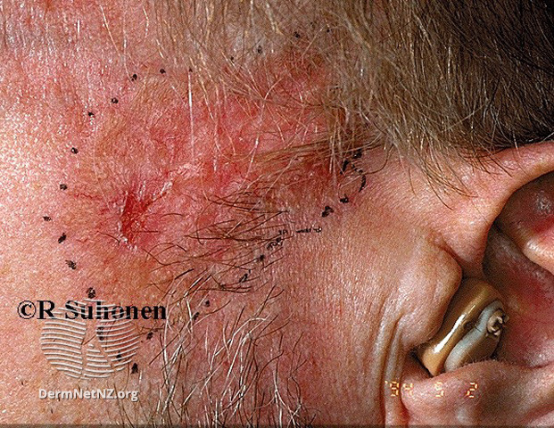 Basal cell carcinoma affecting the face (DermNet NZ lesions-bcc-face-0617).jpg