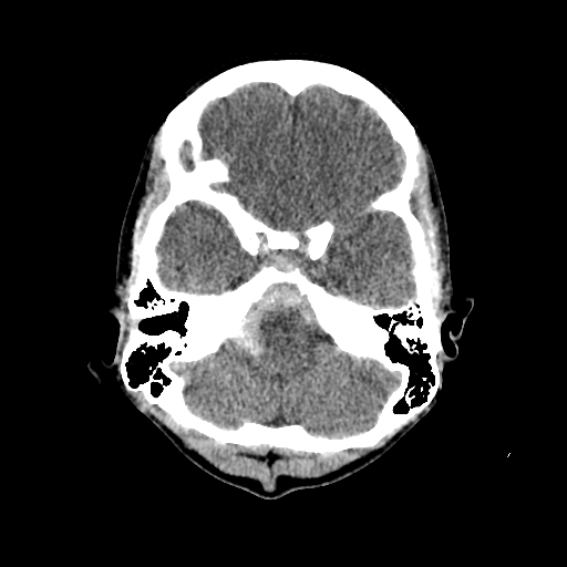 File:Basilar artery perforator aneurysm (Radiopaedia 82455-96597 Axial non-contrast 7).jpg