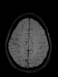 File:Basilar artery perforator aneurysm (Radiopaedia 82455-97733 Axial SWI 45).jpg