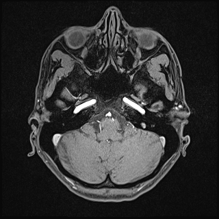 Basilar artery perforator aneurysm (Radiopaedia 82455-97733 Axial T1 fat sat 29).jpg