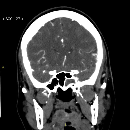 Basilar artery thrombosis (Radiopaedia 16260-15944 B 18).jpg