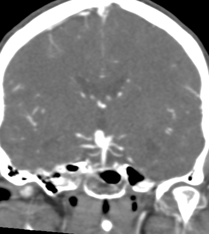 File:Basilar tip aneurysm with coiling (Radiopaedia 53912-60086 B 75).jpg