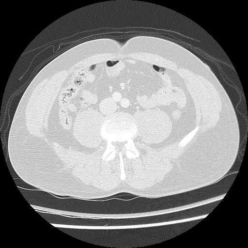 Benign post-traumatic pseudopneumoperitoneum (Radiopaedia 71199-81495 Axial lung window 101).jpg