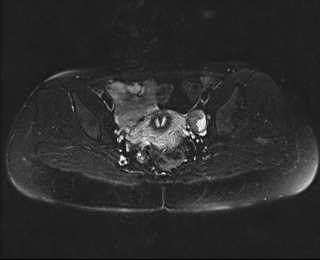 File:Bicornuate bicollis uterus (Radiopaedia 61626-69616 Axial PD fat sat 20).jpg