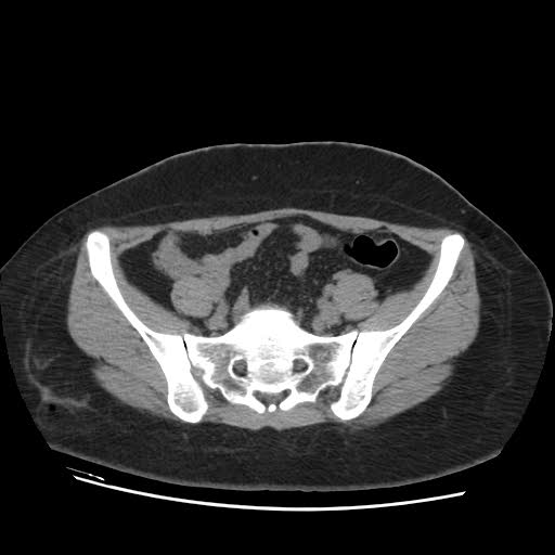 File:Bicornuate uterus- on MRI (Radiopaedia 49206-54296 Axial non-contrast 3).jpg
