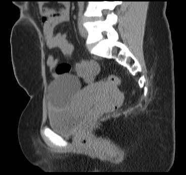 File:Bicornuate uterus (MRI) (Radiopaedia 49206-54296 Sagittal 2).png