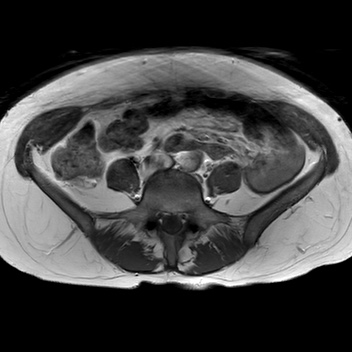 File:Bicornuate uterus (Radiopaedia 61974-70046 Axial T1 12).jpg