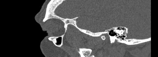 File:Bilateral Ectopic Infraorbital Nerves (Radiopaedia 49006-54084 Sagittal bone window 51).jpg
