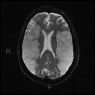 File:Bilateral acute middle cerebral artery territory infarcts (Radiopaedia 77319-89402 Axial DWI 15).jpg