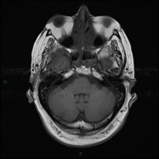 File:Bilateral acute middle cerebral artery territory infarcts (Radiopaedia 77319-89402 Axial T1 6).jpg