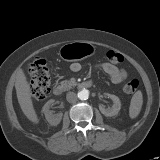 Bilateral delayed nephrogram from renal artery stenosis (Radiopaedia 47681-52362 A 26).png
