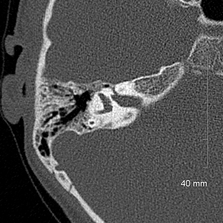 Bilateral grommets (Radiopaedia 47710-52404 Axial bone window 45).jpg