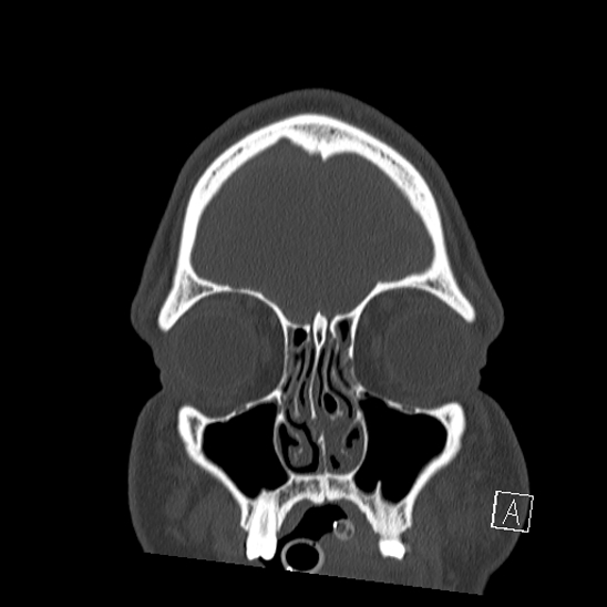 Bilateral occipital condyle fracture (type 2) (Radiopaedia 87675-104089 Coronal bone window 4).jpg